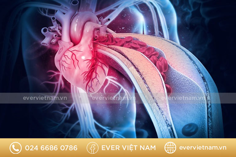 Bệnh nhồi máu cơ tim đang được thử nghiệm điều trị bằng tế bào gốc