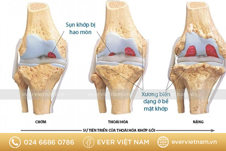 Bệnh thoái hóa khớp có nhiều giai đoạn, khi càng nặng sẽ càng khó điều trị