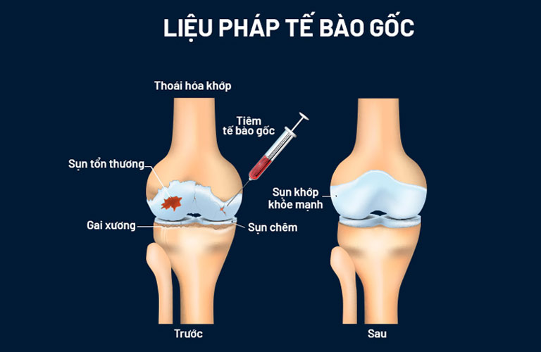 Trong những bệnh có thể chữa bằng tế bào gốc có thoái hóa khớp